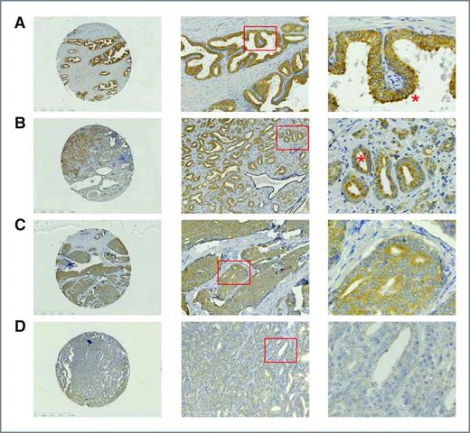 Figure 1. Representative patterns of SPL expression in normal and cancer glands. TMA and high power magnifications (×100 and ×400) of normal glands showing a restricted SPL expression to the epithelial layer (A), well-differentiated Gleason score 5 prostate cancer (B), and poorly differentiated Gleason score 8 (C) and 9 (D) cancers.
