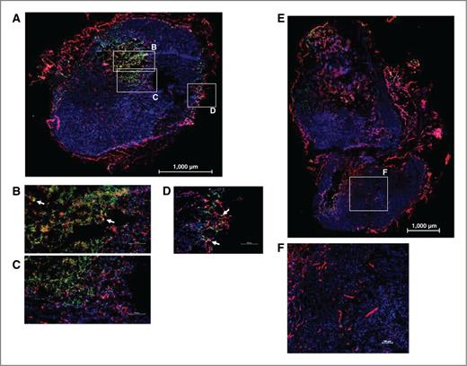 Figure 5. Specific localization of GrB/VEGF121 to PC-3 tumors. Nu/nu bearing human prostate PC-3 tumors were injected intravenously with GrB/VEGF121 or GrB at molar equivalent doses. Four hours after administration, tissues were removed and snap frozen. Sections were stained with immunofluorescent reagents to detect murine blood vessels (CD31; red), nuclei (Hoechst; blue), and GrB (green). Colocalization of GrB into CD31+ tumor vessels appears yellow (representative areas indicated with white arrows). A to D, GrB/VEGF121 localized to the tumor tissue, whereas (E and F) GrB did not. Robust GrB staining was observed in the GrB/VEGF121–treated tumor core (B and C) as well as tumor vessels (D). In contrast, no GrB was detected in GrB-treated tumors. Vessels in all normal organs were unstained by GrB/VEGF121 or GrB.