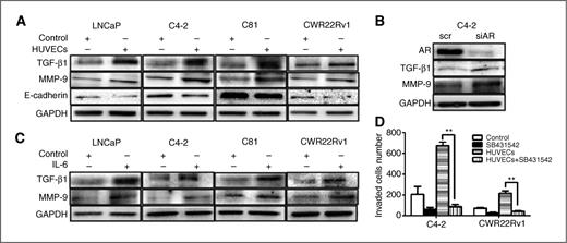 Figure 5. Downregulation of AR signals resulted in decrease in E-cadherin level, but increase in TGF-β1 and MMP-9. A, LNCaP, C4-2, C81, and CWR22Rv1 cells (1 × 105/well) were cocultured with HUVECs (medium for control) for 48 hours in Transwell plates. Prostate cancer cell extracts were obtained for Western blot analyses using antibodies for TGF-β1 (Santa Cruz Biotechnology), MMP-9 (Abcam), and E-cadherin (MAB1838, R&D Systems) expressions. B, C4-2 cells were infected with lentivirus carrying AR-siRNA or scrambled control. Cell extracts were obtained for Western blot analysis for the expression analysis of the indicated molecules. C, LNCaP, C4-2, C81, and CWR22Rv1 cells (1 × 105/well) were treated with 20 ng/mL of IL-6 for 48 hours. Prostate cancer cell extracts were obtained for Western blot analyses for TGF-β1 and MMP-9 expressions. D, C4-2 and CWR22Rv1 cells were cocultured with HUVECs (medium for control) in the presence of TGF-β1 inhibitor, SB431542 for 2 days and invasion assays were conducted. *, P < 0.05; **, P < 0.01.