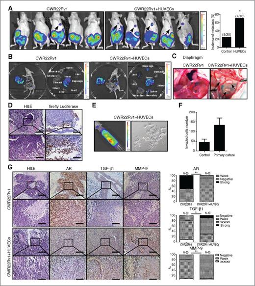 Figure 6. HUVECs treatment enhances prostate cancer metastasis in orthotopic xenografted mice. CWR22Rv1 cells were transfected with luciferase (Luciferase-pcDNA3, Addgene), stable clones were selected, and their luciferase activity was confirmed before injection. 1 × 106 of these cells, either alone or together with HUVECs (10:1 prostate cancer cells:HUVECs), as a mixture with Matrigel, 1:1, total of 20 μL, were orthotopically implanted into the anterior prostates of 8-week-old mice. Tumor growth and metastasis was monitored by examining luminescence using IVIS at 3, 4, 5, and 6 weeks after injection. A, the metastatic incidence shown in 2 groups of mice. B, the imaging data showing primary and metastatic tumors of 2 mice groups. C, the imaging showing diaphragm metastasis. D, H&E and IHC staining of metastatic tumors from diaphragm using antibodies of anti-firefly luciferase antibody (Abcam). E, the imaging showing the ascites metastases obtained from metastatic mouse (left) and primary cultures cells from ascites (right). F, invasion assay of primary cultured CWR22Rv1 from ascites (parental CWR22Rv1 cells as control). G, H&E and IHC staining of primary and metastatic tumors using antibodies of AR, TGF-β1, and MMP-9. *, P < 0.05; **, P < 0.01.