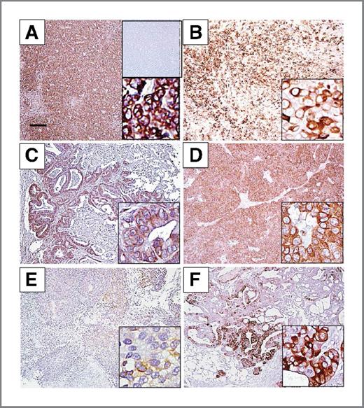 Figure 2. CD74 expression in specimens of several human cancers grown as subcutaneous xenografts in athymic of SCID nude mice: A, Raji Burkitt lymphoma; B, A-375 melanoma; C, Capan1 pancreatic carcinoma; D, Hep-G2 hepatoma; E, HuH-7 hepatoma; and F, NCI-N87 gastric carcinoma. Scale bar in A corresponds to 200 μm (50 μm the higher magnification insets). A nonbinding, isotype-matched antibody showed no evidence of staining (shown only for the Raji xenograft, top right inset in A; scale, 200 μm).