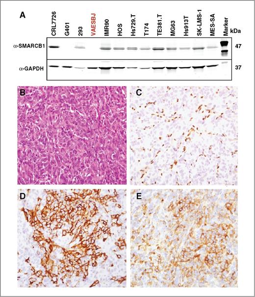 Figure 1. SMARCB1 alteration in VAESBJ sarcoma cell line. A, Western blot analysis in a panel of sarcoma cell lines showing lack of SMARCB1 protein expression in VAESBJ. B–E, hematoxylin–eosin (B) and immunophenotype (C–E) of VAESBJ mouse xenograft tumors, showing C, SMARCB1-negative; D, CD34-positive; and E, EMA-positive tumor cells.