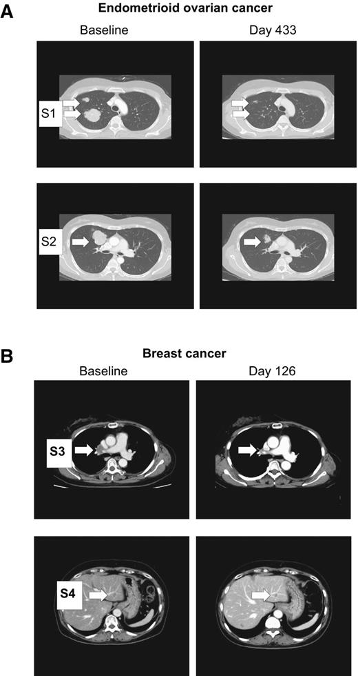 Figure 6. Tumor response by AZ5363 in two patents with somatic AKT1E17K mutation. A, multiple metastases in a patient with endometrioid ovarian cancer have revealed definite tumor shrinkage at day 433 in comparison with start of the treatment (baseline) from 42.3 to 8.1 mm (S1) and from 43.4 to 22.3 mm (S2). B, metastases of mediastinal lymph node and liver in patient with ER+, HER2− breast cancer decreased in size at day 126 in comparison with baseline, from 19.5 to 4.8 mm (S3) and from 17.2 to 14.8 mm (S4). Each arrow shows the location of the metastasis.