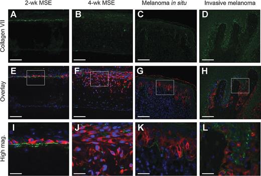 Figure 5. Early cutaneous melanoma invasion in full-thickness human skin equivalent results in disruption of basement membrane component type VII collagen. A–D, representative fluorescence photomicrographs of type VII collagen (green) expression in 2-week (A) and 4-week (B) melanoma skin equivalents (MSE), melanoma in situ (C), and a primary superficial spreading malignant melanoma (D; invasive melanoma). E–H, overlay fluorescence photomicrographs showing relative expression of Melan-A (red) and type VII collagen in 2-week (E) and 4-week (F) MSEs, melanoma in situ (G) and an invasive melanoma (H) with white boxes highlighting area magnified in I–L (blue, DAPI). I–L, 63× magnification of Melan-A and type VII collagen in 2-week (I) and 4-week (J) MSEs, melanoma in situ (K), and an invasive melanoma (L). A–H, scale bars, 100 μm; I–L, scale bars, 25 μm.