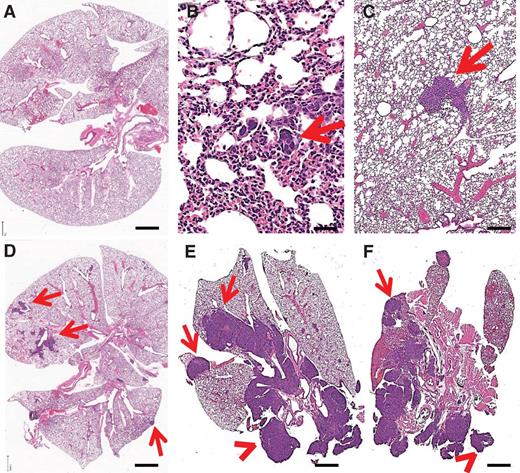 Figure 4. Histologic analysis of lung metastasis. Representative images of hematoxylin and eosin–stained sections of the lungs 28 days after surgical excision of the primary tumor. Similar images could be seen in lung sections from both control and SD-7300–treated mice. The 4T1 tumor metastases can be readily identified by their intense purple staining. A, lungs devoid of metastases. In the other panels, arrows point to metastases of different sizes, from small nidi of tumor cells (B) to larger lesions. In E and F, very large intraparenchymal metastases (arrows) can be seen in addition to extraparenchymal tumor (arrowheads). Size bars, A, D, E, F: 1 mm; B: 400 μm; C: 100 μm.