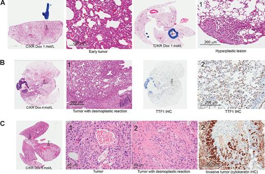 Figure 2. Doxycycline-induced bitransgenic C/KR mice develop lung tumors. A, H&E-stained sections showing C/KR bitransgenic mice developed areas of hyperplastic lesions and early tumors after 1-month doxycycline induction. B, lung sections of a C/KR mouse induced with doxycycline for 4 months. Left, an H&E-stained lung section showing lung with desmoplastic tumors. Right, tumor cells were stained positive of nuclear TTF1. C, lung sections of a C/KR mouse induced with doxycycline for 5 months. Middle panels, H&E-stained lung section with extensive tumors and desmoplasia. Right, cytokeratin stain confirmed invasive lung tumor.