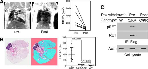 Figure 3. KIF5B–RET expression is required to maintain lung tumors. A, C/KR mice developed MRI-detectable lung adenocarcinoma after doxycycline induction for 5 months. MRI images of representative tumor-bearing mouse before and one month after doxycycline withdrawal. The graph shows comparison of MRI-detectable lung tumor burden before and after doxycycline withdrawal. Each line represents an individual mouse (n = 7). VOI, volume of interest. B, H&E-stained tissue section from lung of a mouse after doxycycline withdrawal (left). Lung tissue image from Genie v1 histology pattern recognition software (Aperio) analysis (middle). Lung tumor burden was analyzed from H&E-stained lung tissues (right; n = 5 in each group). AOI, areas of interest. White, not lung tissue, area excluded; pink, background; blue, normal; purple, hyperplasia/neoplasia, including some areas of normal bronchial epithelia (21). C, comparison of pRET and RET protein in the lungs of C/KR mice induced with doxycycline (before doxycycline withdrawal) and 1 month after doxycycline withdrawal. W, wild-type mouse.