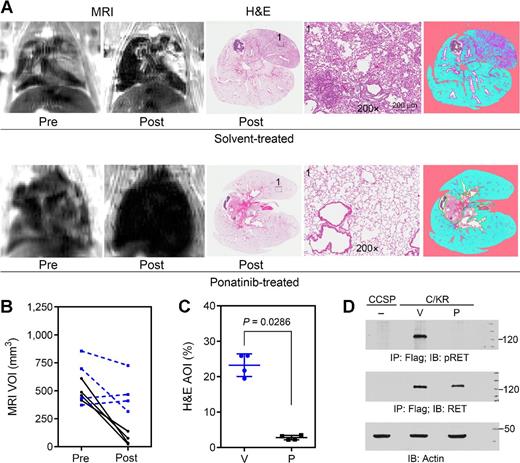 Figure 5. Ponatinib treatment results in tumor regression. A, C/KR mice with MRI-detectable lung tumors were treated with vehicle (top) or ponatinib (30 mg/kg/d, 5 d/wk, p.o.; bottom) for 1 month and then analyzed by MRI again (n = 4 in each group). Lung tissue sections at the end point were stained with H&E. Representative images of MRI, H&E sections, and image from Genie v1 histology pattern recognition software analysis (right) are shown. B, comparison of MRI-detectable lung tumor burden before and after vehicle or ponatinib treatment. Each line represents an individual mouse. Blue, vehicle-treated; black, ponatinib-treated. C, lung tumor burden analyzed from samples of H&E-stained lung tissue sections. V, vehicle-treated; P, ponatinib-treated. D, comparison of pRET, RET, and β-actin proteins in the lungs of CCSP and C/KR mice treated with vehicle or ponatinib. CCSP, negative control mouse.