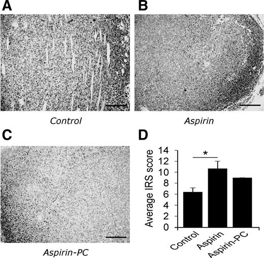 Figure 5. Ovarian tumor tissue hypoxia as assessed by CA-9 immunoreactivity. Micrographs of ovarian cancer tissue using a immunohistochemical stain for CA-9 from (A) saline-treated controls; (B) mice daily dosed with aspirin; or (C) aspirin-PC. CA-9 staining of HeyA8 tumors, 1:500 (4°C overnight, cat. no. NB100-417; Novus Biologicals). Scale bar, 200 μm. D, bar graphs represent our quantitation of immunoreactive scores (IRS) of CA-9 staining multiplied by percentage of cells stained. Statistical analysis: one-way ANOVA with Tukey multiple comparison test.