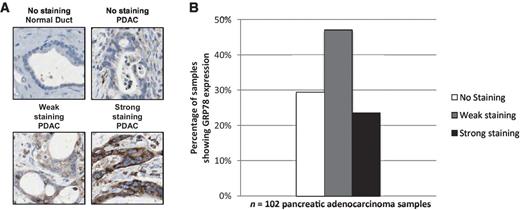 Figure 1. GRP78 protein expression in human TMA. A, representative staining of GRP78 in PDAC samples from human TMA. B, GRP78 expression in patient subset populations.