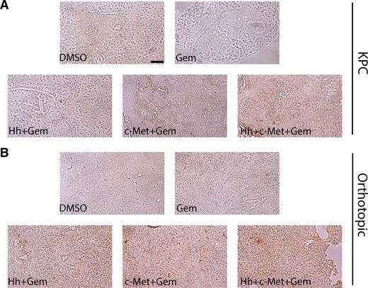Figure 2. Combination of Hh and/or HGF/c-Met inhibitor(s) with gemcitabine in short-term treatment regimen results in enhancement tumoral cell death in the transgenic (KPC) and orthotopic mouse models. A and B, The KPC (A) and orthotopic (B) mouse models of PDAC were treated with Hh and/or HGF/c-Met inhibitor(s) and biweekly gemcitabine as shown in Fig. 1A. Primary tumors from both mouse models were harvested on the last day of treatment and subjected to TUNEL staining for apoptotic cells. Representative images for each treatment group in both models are shown. The images are representative of one experiment. Mice that died before the completion of the planned treatment or whose quality of tumor was not adequate for analysis due to necrosis were excluded. Gem-gemcitabine (n = 8), Hh-Hh inhibitor + gemcitabine (n = 9), c-Met- HGF/c-Met inhibitor + gemcitabine (n = 7), DMSO-vehicle control (n = 14), Hh + c-Met + gemcitabine (n = 8). Scale bar, 200 μm.