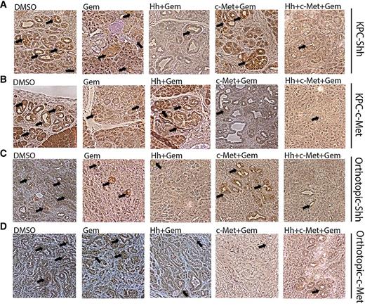 Figure 5. Single c-Met or Hh inhibitor treatment leads to the enhanced expression of the other target and the combination of both c-Met and Hh inhibitors suppresses the expression of both targets more effectively. A and B, Representative IHC images of primary tumors from the transgenic mouse model-KPC stained for expression of Shh (A) and c-Met (B) showing upregulation of Shh in the c-Met treatment group and vice versa, that can be overcome by combination treatment of Hh and c-Met inhibitors with gemcitabine. C and D, Representative IHC images of primary tumors from the orthotopic mouse model stained for expression of Shh (C) and c-Met (D) showing upregulation of Shh in the c-Met treatment group and vice versa, that can be overcome by combination treatment of Hh and c-Met inhibitors with gemcitabine. Mice in both models were treated for 1 week (as shown in Fig. 1A). The data are representative of one experiment. Mice that died before the completion of the planned treatment or whose quality of tumor was not adequate for analysis due to necrosis were excluded. Arrows, positive staining. Gem-gemcitabine (n = 8), Hh-Hh inhibitor + gemcitabine (n = 9), c-Met- HGF/c-Met inhibitor + gemcitabine (n = 7), DMSO-vehicle control (n = 9), Hh + c-Met + gemcitabine (n = 8). Scale bar, 200 μm.