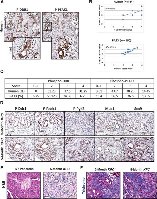 Figure 1. DDR1 signaling in human and mouse PDA. A, IHC detection of phospho-DDR1 and phospho-PEAK1 in human PDA. TMAs of primary human PDA (44 samples) demonstrated phospho-DDR1 and phospho-PEAK1 localized to similar regions. B, Pearson correlation of p-PEAK1 and p-DDR1 expression in human and patient-derived tumor xenograft (PATX) TMA samples. C, Percent of TMA samples positive for p-DDR1 and p-PEAK1. Scoring system is denoted as: low or no reactivity (0–1), moderate reactivity (2), strong reactivity (3), and very strong reactivity (4). D–F, Histologic analyses of the KPC (LSL-KrasG12D/+; LSL-Trp53R172H/+; p48Cre/+) GEMM of PDA. D, IHC detection of phospho-Ddr1, phospho-Peak1, phospho-Pyk2, Muc1, and Sox9 in KPC tumors. Ddr1 activation and downstream signaling through effectors such as Peak1 and Pyk2 was present in early PanIN lesions (similar to regions positive for Muc-1 staining) and in advanced adenocarcinoma (similar to regions of Sox9 staining). Tissue from an early (3-month) and advanced (5-month) stage of the KPC model was evaluated. E, H&E histology of normal WT pancreas and PDA in a 5-month-old KPC mouse. F, Trichrome analysis of PDA from 3- and 5-month-old KPC animals.