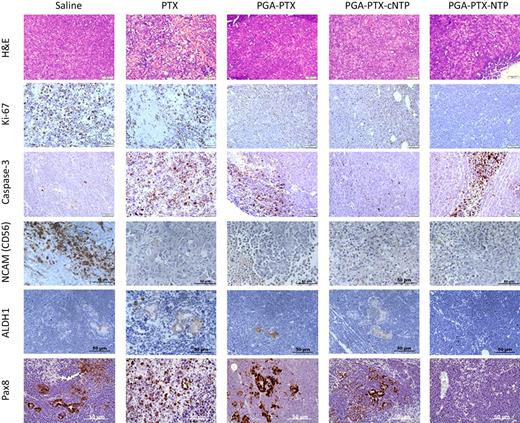 Figure 6. Hematoxylin and eosin (H&E) staining of tumors show similar histology characteristics in the different treated groups. Xenografts are composed mainly of blastemal cells. Ki-67 staining shows complete absence of proliferation in PGA–PTX–NTP treated tumors, while in all other treatment groups there is substantial proliferation. Caspase-3 staining shows extensive apoptosis in tumors treated with free PTX, PGA–PTX–NTP and PGA–PTX. In tumors treated with PGA–PTX–NTP apoptosis is seen only inside the tumors, while in PGA–PTX treated tumors apoptosis is only seen at the margins. NCAM (CD56) staining was positive in section from the saline-treated group, while slightly positive in sections from PGA–PTX and PGA–PTX–cNTP and negative in sections from PGA–PTX–NTP treatment. Additionally, PTX treatment caused extensive apoptosis resulting in negative NCAM staining. ALDH1 staining showed positive staining in all groups except PGA–PTX–NTP. Pax8 staining was positive in all groups except PGA–PTX–NTP. Scale bars, 50 μm; objective, ×400.