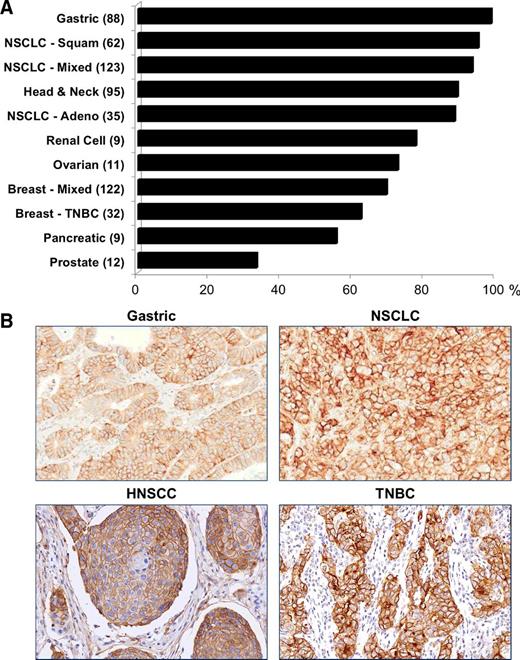 Figure 1. Relative prevalence of 5T4 expression in clinical tumor samples. A, IHC for 5T4 expression was conducted to determine the prevalence of 5T4 expression in tumor samples from patients with various cancers. The values represent the percentage of tumor samples that have detectable levels of 5T4 immunostaining. TNBC, triple-negative breast cancer; NSCLC, non-small cell lung cancer. The number in parentheses represents the number of tumor samples tested for each cancer type. B, Representative images of 5T4 immunostaining in various cancer types.