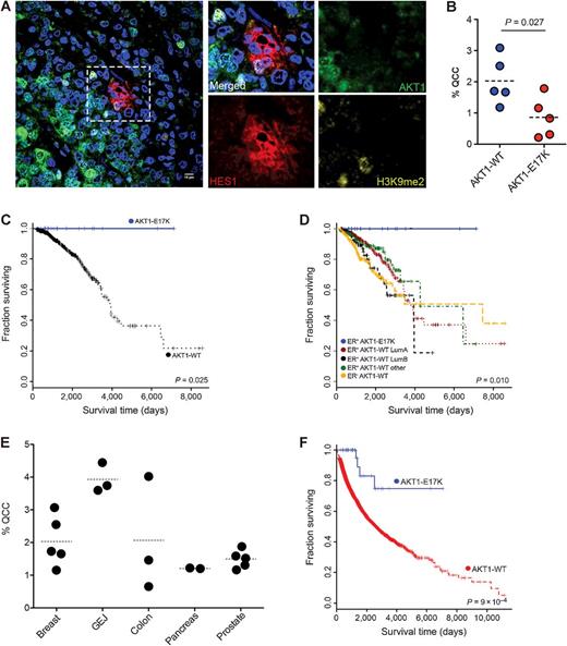 Figure 4. AKT1-E17K, QCCs, and clinical outcome in human cancers. A, Illustrative image of QCC in single section from a human ER+ primary breast tumor (blue, DAPI nuclear stain). B, percentage of QCCs in individual human breast tumors. C, Kaplan–Meier plots of overall survival in ER+/AKT1-E17K breast cancer patients versus patients with ER+/AKT1− WT breast tumors. D, ER+/AKT1-WT breast tumors subdivided by known molecular subtypes (from TCGA). E, The percentage of QCCs in individual primary tumors from a variety of epithelial cancer types (i.e., breast, gastroesophageal junction, colon, pancreas, prostate). F, Kaplan–Meier plot of overall survival in all cancer patients with AKT1-E17K mutation versus AKT1-WT (from TCGA).