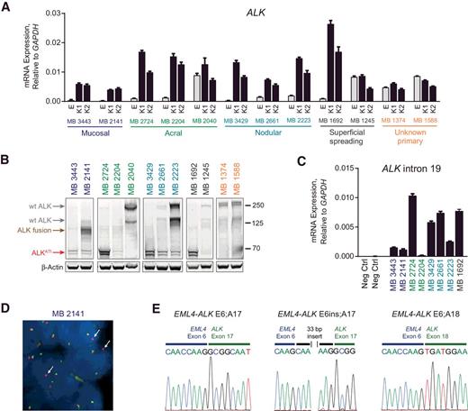 Figure 1. Identification of melanoma tumors expressing wt ALK, ALKATI, and an EML4-ALK fusion. A, ALK mRNA expression was quantified in melanoma PDX tumors by qRT-PCR analysis with primers located in early exons (E) or exons within the kinase domain (K1, K2) of ALK. Expression was normalized to GAPDH and error bars represent SEM of triplicate reactions. The 12 ALK expression–positive tumors out of 45 total PDX tumors analyzed are shown. B, Immunoblot analysis of ALK-positive PDX tumor lysates. C, Expression of ALK intron 19 was quantified by qRT-PCR. Expression was normalized to GAPDH and error bars represent SEM of triplicate reactions. D, FISH analysis of the MB 2141 PDX tumor using ALK specific 5′ (green) and 3′ (red) break-apart probes. E, Sanger sequencing analysis of EML4-ALK fusion variant transcripts. PCR products were generated from MB 2141 PDX cDNA using an EML4-exon 4 forward primer and ALK exon 17 or 20 reverse primers. PCR products were subcloned and analyzed by Sanger sequencing.