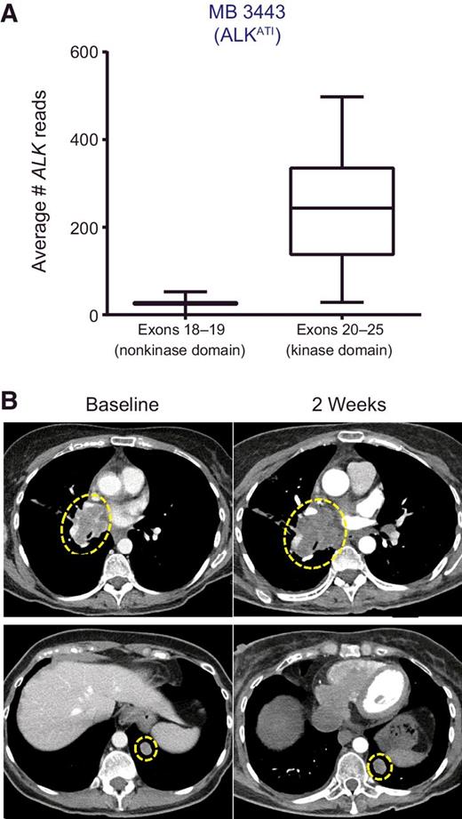 Figure 5. A patient with melanoma expressing ALKATI does not respond to treatment with entrectinib. A, The patient specimen was analyzed for ALK gene expression using targeted RNA next-generation sequencing. The average number of sequencing reads for exons 18–19 (upstream of the kinase domain, not included in ALKATI) and exons 20–25 (kinase domain included in ALKATI) of the ALK gene are shown. B, Radiographic images from CT scans performed prior to treatment (baseline) and 2 weeks after the start of treatment are shown for a right hilar pulmonary tumor nodule (top) and a left lower lobe pulmonary tumor nodule (bottom).
