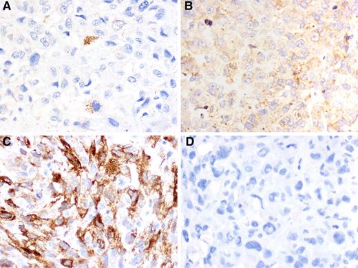 Figure 1. Representative LC3B and HSP27 labeling. Variable tumoral labeling and intensity was seen (see Table 2). Illustrated are some examples of staining patterns seen. Tumor with A scattered cytoplasmic and punctate LC3B labeling; B, diffuse cytoplasmic and punctate LC3B labeling; C, positive HSP27 labelin; and D, negative HSP27 labeling; magnification, ×400.