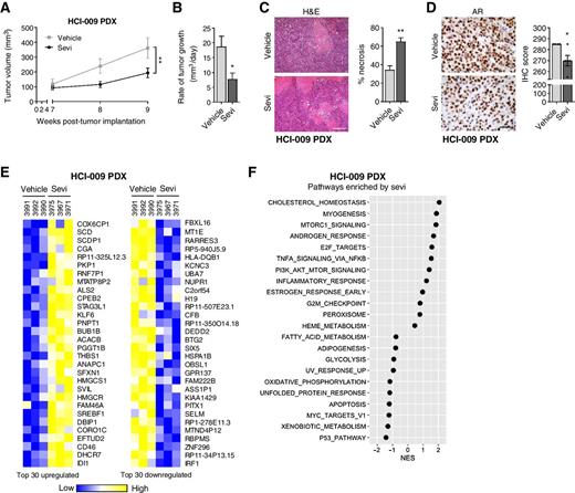 Figure 3. AR-positive TNBC PDX sensitivity to AR-targeted therapy. HCI-009 PDX tumor portions were injected into the mammary fat pads of female NSG mice. Mice were treated daily with vehicle or 150 mg/kg/day seviteronel (sevi). Tumor volume was measured with calipers (A) and the rate of tumor growth per day over 2 weeks was calculated (B). The percentage of tumor necrosis (C) and AR+ cells per tumor (D) were quantified; representative images of H&E staining. Scale bars, 200 and 50 μm, respectively. Shown are the top 30 up- and downregulated genes (E) and most highly correlated biological pathways (F) identified by GSEA in RNA-seq data from HCI-009 PDX tumors from mice treated with seviteronel. Mean ± SEM (*, P < 0.05; **, P < 0.01). NES, normalized enrichment score.