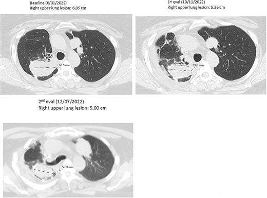 Figure 1. Evidence of distant shrinkage of a leiomyosarcoma metastatic lung lesion after local injection of AdAPT-001 in a subcutaneous abdominal lesion.