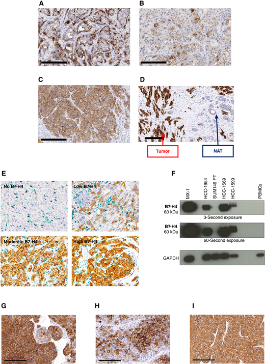 B7-H4 is highly expressed in primary human breast cancers and tumor models. A–C, B7-H4 expression in primary human breast cancer was measured by B7-H4 IHC (DAB) with hematoxylin counterstain. Representative images from (A) HR+HER2−, (B) HER2+, and (C) TNBC molecular subtypes are shown. D, Comparison of expression in tumor tissue and normal adjacent mammary glands (NAT). E, B7-H4 (DAB) and CD68 (Vina Green, a macrophage marker) co-staining of primary human breast cancers with varying levels of B7-H4 expression: no, low, moderate, and high. F, Western blot of B7-H4 in primary human PBMCs, with human breast cancer cell lines for comparison. GAPDH is used as a loading control. G–I, B7-H4 expression (DAB, brown stain) with hematoxylin counterstain in human breast cancer PDXs grown in NSG mice: (G) PDX-BRX-26305 (H-score = 219), (H) PDX-BRX-11380 (H-score = 235), and (I) PDX-BRX-24301 (H-score = 205). All images are shown at 20× objective. Scale bar, 200 µm.