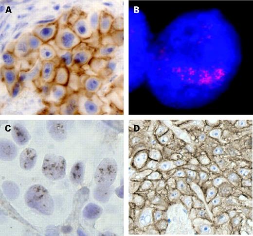 Figure 1. A, HER-2 overexpression (3+) shown by immunohistochemistry in the patient's primary tumor. B, HER-2 amplification by single-color FISH (red signals). C, CISH shows HER-2 amplification (cluster of brown peroxidase reaction deposits) in the nuclei of JIMT-1 xenograft cells. D, HER-2 protein overexpression in the xenograft tumor tissue.