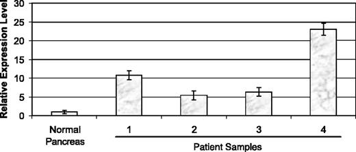 Figure 2. Real-time PCR analysis of Plk1 mRNA signal in human pancreatic tumor tissue samples. Procedure and analysis were run using a protocol identical to that described in Fig. 1.