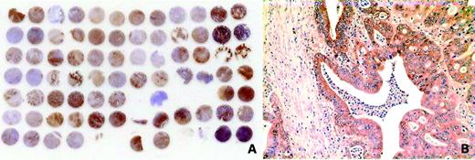 Figure 3. Immunostaining of a pancreatic tumor tissue microarray. A, overview of the pancreatic tissue microarray (two cores per sample). B, magnified view (×40) of a tissue microarray section with highly positive staining for Plk1.