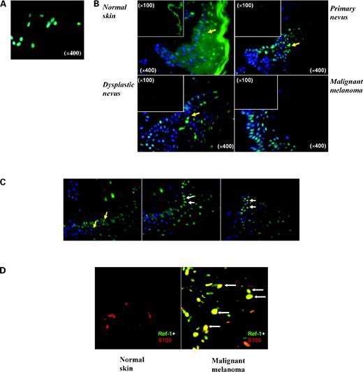 Figure 2. A, subcellular distribution of APE/Ref-1 in human metastatic melanoma c83-2c cells. Subcellular localization of APE/Ref-1 was visualized by performing indirect immunofluorescence. Cells were stained using a mouse antihuman Ref-1 antibody (green) and the nuclei were counterstained with DAPI (blue). B, representative examples of human melanoma or nevi displaying significant increase of APE/Ref-1 expression levels compared with normal skin using indirect immunohistofluorescence assay. The paraffin-embedded sections, including normal skin, different nevi, or melanoma biopsies, were incubated with anti-APE/Ref-1 antibody and the relative expression levels of Ref-1 were visualized by Alexa Fluor 488–conjugated goat antimouse antibody (green). All the tested samples were counterstained by DAPI. Elevated APE/Ref-1 levels were observed with stronger green fluorescence. Costaining sections with DAPI and Ref-1 antibody exhibits specific Ref-1 expression in cell nucleus. Each is the merging view of DAPI and Ref-1 at ×400 magnification. Insets, view of Ref-1 staining at ×100 magnification. C, translocalization of Ref-1 from cytoplasm to nuclear was observed in compound primary intradermal nevi. Left, normal skin section connected to the nevi and most of Ref-1 located in cytoplasm (arrows); middle, adjacent normal skin with part of nevi section and some cells exhibited nuclear Ref-1 localization at the nevi part (arrows); right, nevi section with strong nuclear localized Ref-1 expression (arrows). D, specific expression of Ref-1 in human melanoma sections. Paraffin-embedded sections from normal skin or melanoma biopsies were coincubated with anti-APE/Ref-1 and anti-S100 antibodies as described in Materials and Methods. The relative expression levels of Ref-1 and S100 were represented by fluorescence density (green and red, respectively). Left, normal skin only showed weak S100 staining; right, in melanoma, significantly elevated APE/Ref-1 was observed with yellow staining.
