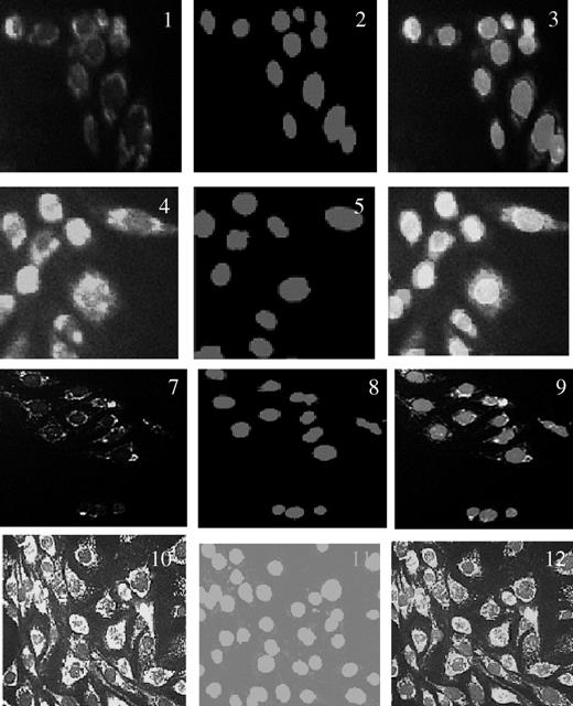 Figure 4. AIF protein localization in pancreatic adenocarcinoma cell lines treated and untreated with TSA for 6 h. 1–3, IMIM-PC-1 untreated cells, AIF staining (1), nuclei staining with Hoestch 33342 (2), and overlay staining (3). 4–6, IMIM-PC-1 cells treated with 1 μmol/L TSA for 6 h, AIF staining (4), nuclei staining with Hoestch 33342 (5), and overlay staining (6). 7–9, IMIM-PC-2 untreated cells, AIF staining (7), nuclei staining with Hoestch 33342 (8), and overlay staining (9). 10–12, IMIM-PC-2 cells treated with 1 μmol/L TSA for 6 h, AIF staining (10), nuclei staining with Hoestch (11), and overlay staining (12).