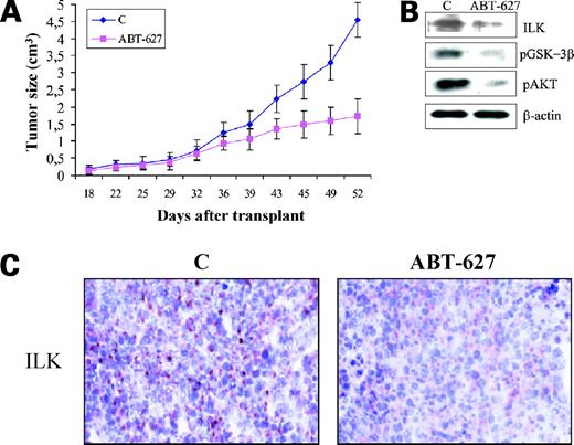 Figure 6. Blockade of ETAR by ABT-627 inhibits ILK signaling and tumor growth in vivo. A, antitumor activity of ABT-627 treatment on HEY human ovarian carcinoma xenografts. Mice were given injections of 1.5 × 106 HEY cells s.c. in the dorsal flank. After 7 d, groups of 10 mice were treated i.p. for 21 d with drug vehicle or with ABT-627 (2 mg/kg/d). Points, mean of three different experiments for a total of 20 mice in each experiment; bars, ±SD. ABT-627 caused a significant inhibition of HEY tumor growth in treated animals over a 21-d dosing regime. The comparison of time course of tumor growth curves by two-way ANOVA with group and time as variables showed that the group-by-time interaction for tumor growth was statistically significant (P < 0.001). B, immunoblotting for ILK, pGSK-3β, and pAkt expression in HEY tumor xenografts. C, comparative immunohistochemical analysis of ILK expression. ABT-627 causes a significant inhibition of ILK expression in HEY tumor xenografts compared with tumors of control animals (original magnification, ×250).