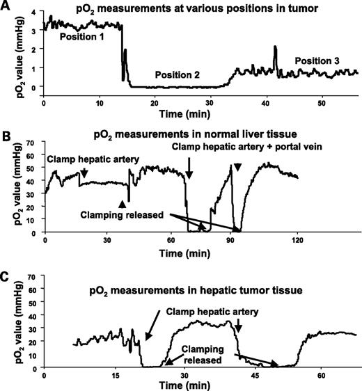 Figure 3. Oxygen tension measurements in hepatic tumors and normal liver tissue. Changes in pO2 in HRE reporter–transduced RH7777 Morris hepatoma after small changes in position of the OxyLite probe (A); in normal liver tissue before, during, and after clamping of the hepatic artery; as well as both the hepatic artery and portal vein (B) and in the same liver tumor (A) in a fourth position with clamping of the hepatic artery alone (C). A to C are from the same animal; measurements were made sequentially.