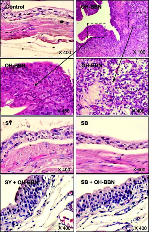 Figure 2. Histopathology of the urothelium of mice in OH-BBN–induced bladder carcinogenesis. At the end of the study detailed in Fig. 1C, urinary bladders were processed for H&E staining, and a representative picture is shown for each group. Normal urothelial mucosa, characterized by epithelium of <3 layers without any anaplasia, is shown in control, silymarin, and silibinin groups (×400). OH-BBN–treated mouse urothelium showing localized cellular proliferation, with invasive carcinoma infiltrating the submucosa or muscle layer with undifferentiated features (×100; subsets, ×400). Silymarin + OH-BBN and silibinin + OH-BBN groups show epithelium of ≥3 layers with diffused mucosal dysplasia.