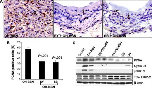 Figure 4. Effect of silymarin and silibinin feeding on OH-BBN–induced urothelial cell proliferation and mitogenic signaling. Immunohistochemical and immunoblot analyses of urothelial tissue samples obtained from the experiment detailed in Fig. 1C were done to study the molecular biomarkers and events associated with proliferation. A, immunohistochemical staining for PCNA (magnification, ×400) in urothelium was done as detailed in Materials and Methods. Arrows, PCNA-positive cells. B, the proliferating cells were quantified by counting PCNA-positive cells over total cells in five randomly selected fields at ×400 magnification from 10 different samples in each group. The proliferation index was determined as (number of positively stained cells × 100) / total number of cells counted. Columns, mean proliferation index in each group; bars, SE. C, bladder tissue samples were randomly taken from each group and analyzed for PCNA, cyclin D1, and phosphorylated and total ERK1/2 protein levels by immunoblotting. Membrane was stripped and reprobed with β-actin as loading control.