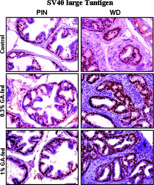Figure 2. Effect of oral feeding of gallic acid on the expression of SV-40 large T antigen in the dorsolateral prostate of TRAMP mice. Immunohistochemical staining was based on DAB staining as detailed in Materials and Methods. Representative DAB-stained tissue specimens are illustrated here from positive control and 0.3% and 1% gallic acid–fed groups (magnification, ×400) showing brown staining for the expression of SV-40 large T antigen in PIN and well-differentiated (WD) adenocarcinoma.