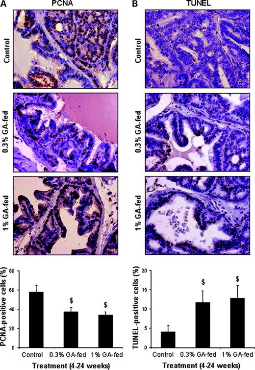 Figure 4. Antiproliferative and proapoptotic effects of gallic acid feeding in TRAMP mice. A, in vivo antiproliferative effect of gallic acid feeding on dorsolateral prostate of TRAMP. Immunohistochemical staining for PCNA in prostate was based on DAB staining as detailed in Materials and Methods. Representative DAB-stained tissue specimens from positive control and gallic acid–fed groups showing brown-colored PCNA-positive cells are depicted at ×400 magnification. Quantification of PCNA-positive cells for determination of proliferation index is shown as mean ± SE in each group. $, P < 0.05. B, in vivo proapoptotic effect of gallic acid feeding on dorsolateral prostate in TRAMP mice. Apoptosis was analyzed by TUNEL staining in prostate tissues as detailed in Materials and Methods. Representative DAB-stained tissue specimens from positive control and gallic acid–fed groups showing brown-colored TUNEL-positive cells are depicted at ×400 magnification. Apoptotic index was calculated as the number of positive cells × 100 / total number of cells counted under ×400 magnification in 10 randomly selected areas in each sample. Bars, SE. $, P < 0.05. A and B, statistical significance of difference between positive control and gallic acid–fed groups was analyzed by unpaired two-tailed Student's t test. P values < 0.05 were considered significant.