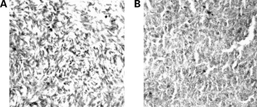 Figure 1. Immunohistochemical staining of EpoR in control (healthy) ovary (A) and ovarian endometrioid adenocarcinoma grade 1 (B). A representative example of ovarian carcinoma expression EpoR (magnification, ×200).