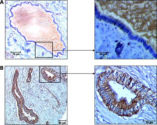 Figure 7. SphK1 expression is up-regulated in pancreatic adenocarcinoma ductal lesions versus normal ductal epithelium. Immunohistochemistry was done with the anti-SphK1 antibody using a high-density tissue array of normal pancreas (autopsy; n = 10; A) and pancreatic adenocarcinoma (n = 60; B). A, a major normal duct whereby ductal cells show only a faint staining for SphK1. B, an adenocarcinoma lesion whereby a robust immunostaining is present in all ductal cells.