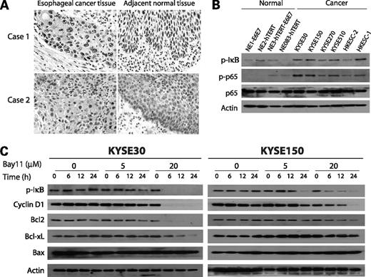Figure 1. NF-κB activation in human esophageal cancer and blockade of NF-κB pathway by Bay11 in human esophageal cancer cells. A, immunohistochemical staining for phospho-p65 (p-p65) in a human ESCC tissue array. Two pairs of cancer and matching adjacent normal tissue showing overexpression of p-p65 in the nuclei of cancer cells were shown. B, Western blot analysis of protein expression of phospho-IκB (p-IκB) in immortalized normal esophageal epithelial cell lines and esophageal cancer cell lines. Actin was included as internal loading control. The expression level of p-IκB was higher in the cancer cell lines compared with the normal cell lines. C, Western blot analysis of p-IκB, cyclin D1, Bcl2, Bcl-xL, and Bax expressions in the cell lysates of KYSE30 and KYSE150 treated with different concentrations of Bay11 or vehicle (DMSO) for different durations.