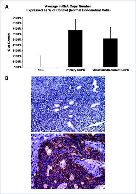 Figure 1. A, EpCAM mRNA expression levels in primary and metastatic/recurrent USPC compared with NEC. EpCAM transcript was found to have significantly higher expression in primary and metastatic/recurrent carcinoma when compared pairwise to fresh-frozen normal endometrial tissues (P < 0.0001). B, representative image of normal endometrium showing negative EpCAM immunohistochemical reaction (top, ×200), and a representative primary USPC showing strong (3+) EpCAM expression by immunohistochemistry (bottom, ×400).