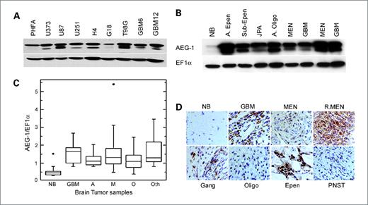 Figure 1. AEG-1 expression is upregulated in diverse brain tumors including malignant glioma. A, expression of AEG-1 in PHFA and in a panel of human malignant glioma cells was analyzed by Western blot analysis. EF1α was used as an internal control to ascertain equal loading. B, expression of AEG-1 protein in normal brain tissue and archival clinical human brain tumor samples by Western blot analysis. EF1α was used as an internal control for protein loading. A.Epen, anaplastic ependymoma; JPA, juvenile pilocytic astrocytoma; A. Oligo, anaplastic oligoastrocytoma. C, relative expression of AEG-1 in normal brain tissue and primary brain cancer samples. The expression levels are presented as a ratio between AEG-1 and loading control EF1α. NB, normal brain; A, anaplastic astrocytoma (grade II and grade III); M, meningiomas; O, oligo-dendroglioma and oligo-astrocytoma; Oth, others such as ependymoma, ganglioma, peripheral neural sheath tumor, etc. D, immunohistochemical staining for AEG-1 in normal brain tissue and formalin-fixed, paraffin-embedded tissue sections of various brain tumors. Signals were developed with 3,3′-diaminobenzidine chromogen (brown, AEG-1) and counterstained with hematoxylin.
