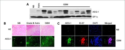 Figure 2. AEG-1 expression is more profound in the clinical samples of GBM. A, expression of AEG-1 protein in normal brain tissue and in tissues samples of astrocytoma and GBMs by Western blot analysis. EF1α was used as an internal control for protein loading. B, immunofluroscence staining of AEG-1 in normal brain and in astrocytic tumor tissue array (bottom). Top, H&E stain. C, immunofluroscence staining of AEG-1 (green) and ki67 (red) in normal brain and in GBM. Nuclei were stained with 4′,6-diamidino-2-phenylindole (DAPI).