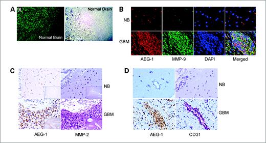 Figure 3. AEG-1 expression is more prominent in the invasive margin of rat glioma, and AEG-1 expression is associated with MMP-2, MMP-9, and CD31 expression in human glioma tissue. A, L9 rat glioma cells were implanted in syngeneic rats. Immunofluorescence studies (left, green) and immunohistochemical studies (right, brown) were done in sections containing tumor and adjacent normal brain. B, the sections of normal brain (NB) and GBM were immunostained for AEG-1 (red) and MMP-9 (green). Nuclei were stained with 4′,6-diamidino-2-phenylindole (DAPI). C, serial sections of formalin-fixed, paraffin-embedded normal brain and GBM were stained with a rabbit polyclonal AEG-1 and a rabbit polyclonal MMP-2. Signals were developed with 3,3′-diaminobenzidine chromogen (brown, AEG-1) or vector very intense purple (purple, MMP-2) and counterstained with hematoxylin. D, the sections of normal brain and GBM were immunostained for AEG-1 and the endothelial cell marker CD31. Immunohistochemical analysis showed complete overlap of AEG-1 and CD31 in tumor blood vessel.