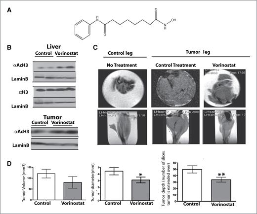 Figure 1. Vorinostat significantly reduces tumor growth in the bone microenvironment. A, molecular structure of vorinostat. B, Western blot showing total and acetylated histone H3 levels in whole cell lysates from livers (n = 3) and tumor tissues of vorinostat-treated and control animals injected with PC3 prostate cancer cells. Total histone H3 and lamin B loading controls validated the increased acetylation. C, cross-sectional and axial MRI images from tumor-bearing legs were collected with a 7 Tesla 3D imager (gradient echo, Bruker FLASH3D, TR = 100 ms, TE = 6.5 ms, FA = 90 degrees, TT = 14 minutes, 10 mm × 10 mm × 19 mm, data size = 64 × 64,128, image resolution per pixel = 0.156 mm × 0.156 mm × 0.148 mm). D, tumor size measurement are shown for tumor volume, diameter, and number of slices that comprise the entire depth of the tumor. Parameters were obtained with ANALYZE image analysis software (n = 5 each group; *P < 0.1, **P < 0.05).