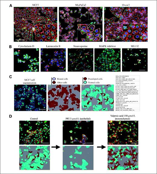 Figure 1. Bespoke image analysis across distinct cancer cell types. A cellular morphology assay was designed to monitor, in detail, changes in cytoskeletal and nuclear architecture across multiple cancer cell types. This four-wavelength multiplex assay consisted of the DNA binding dye, DAPI (blue), an actin cytoskeleton marker, Phalloidin (red), anti–β-tubulin antibody (green) to monitor the microtubule cytoskeleton, and the cytoplasmic marker, HCS cell mask. A, an image analysis algorithm created using Definiens Cellenger first segments individual cells by identifying nuclear and cytoplasmic boundaries. Cell and nuclear segmentation are indicated by red and white pseudocolor, respectively. B, examples of the broad spectrum of heterogenic phenotypes captured when applying this assay after compound incubation. Examples shown are from MCF7-wt cells. C, following cell segmentation, the Definiens image analysis algorithm captures distinct parameters for each individual cell, which represent a variety of geometric, intensity, subcellular localization and texture features. Based on a selection of feature parameters, the algorithm assesses changes across specific subpopulations, such as normal, round, and pseudopod (pseudopod class refers to elongated cells containing a higher proportion of filamentous actin–containing projections than normal cells). D, validation of this subpopulation analysis was done by monitoring transition to epithelial and mesenchymal phenotypes following treatment with PP2 and valproic acid, respectively. Scale bars, 100 μm.