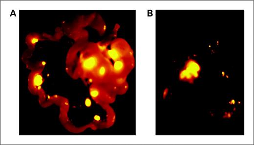 Figure 3. The grading scheme in Table 2 is illustrated using fluorescence images of the small bowel (A) and liver (B) taken from a control animal after 2 weeks of treatment. Both images are typical images of this study. Grade 4 metastases were identified in the porta hepatis and small bowel mesentery. Grade 2 metastases were visualized in the liver parenchyma.