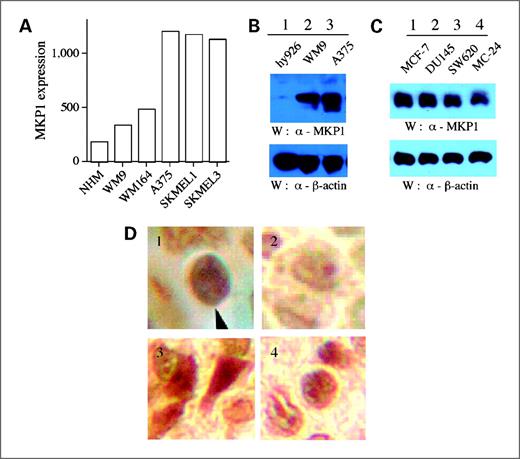 Figure 5. MKP1 is expressed at significant levels in human melanoma cell lines and tissue samples. A, MIP1 transcripts in normal human melanocytes (NHM) and human melanoma cell lines were quantified by array analysis (signals + SD). B, expression of MKP1 protein in human melanoma cell lines and hy926 endothelial cell line were quantified by Western blotting with antibodies as indicated. C, expression of MKP1 protein in cancer cell lines as quantified by Western blotting with antibodies as indicated. D, representative immunohistochemistry images (magnification, ×40): 1, the variably stained nuclei of benign melanocytes (arrow); 2, junctional nevus; 3, radial growth melanoma; and 4, advanced vertical growth melanoma. Immunohistochemistry results can be found in Table 1.